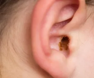 A close-up of an ear with ear wax showing. 